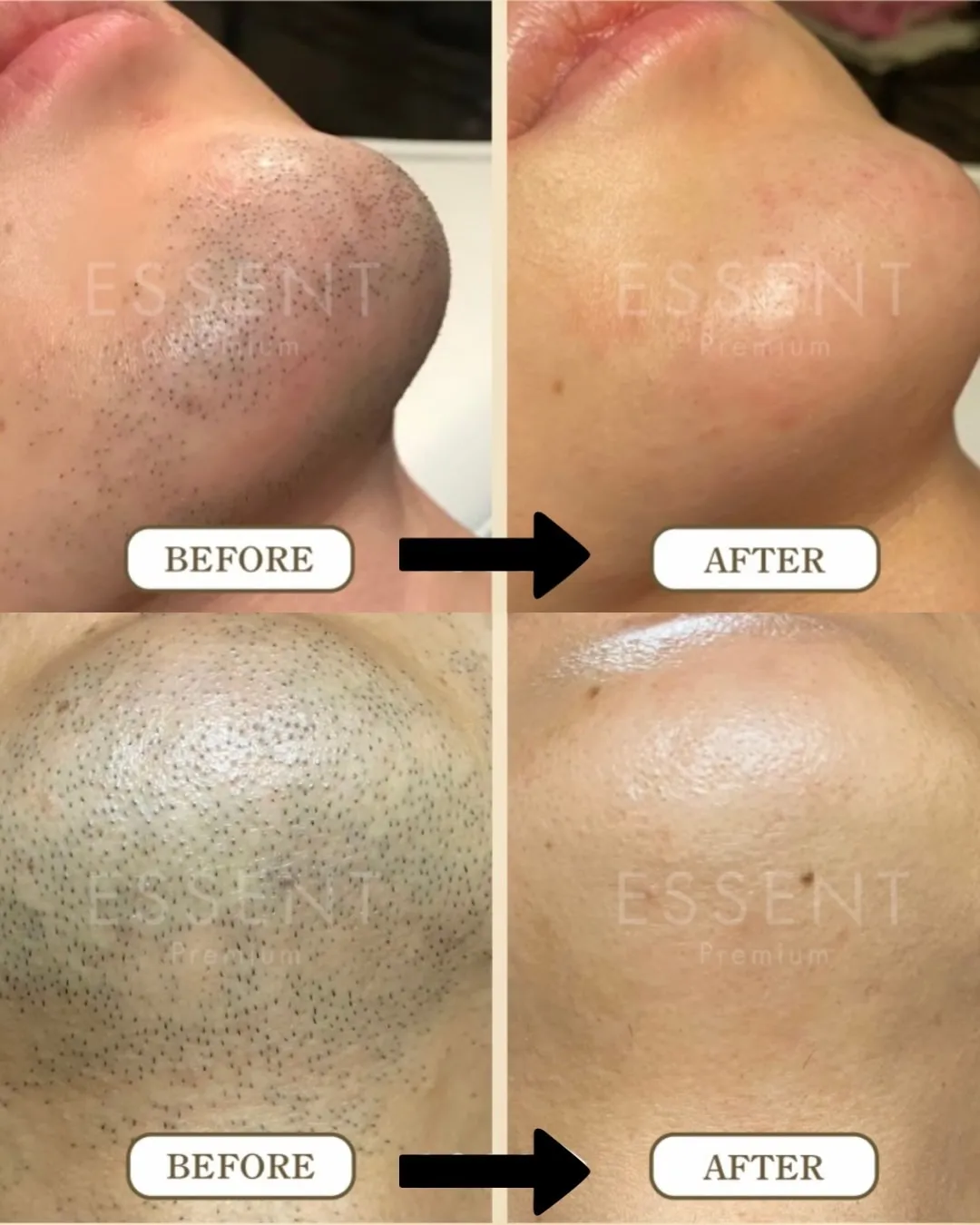 【脱毛の効果をしっかり感じたい方へ】