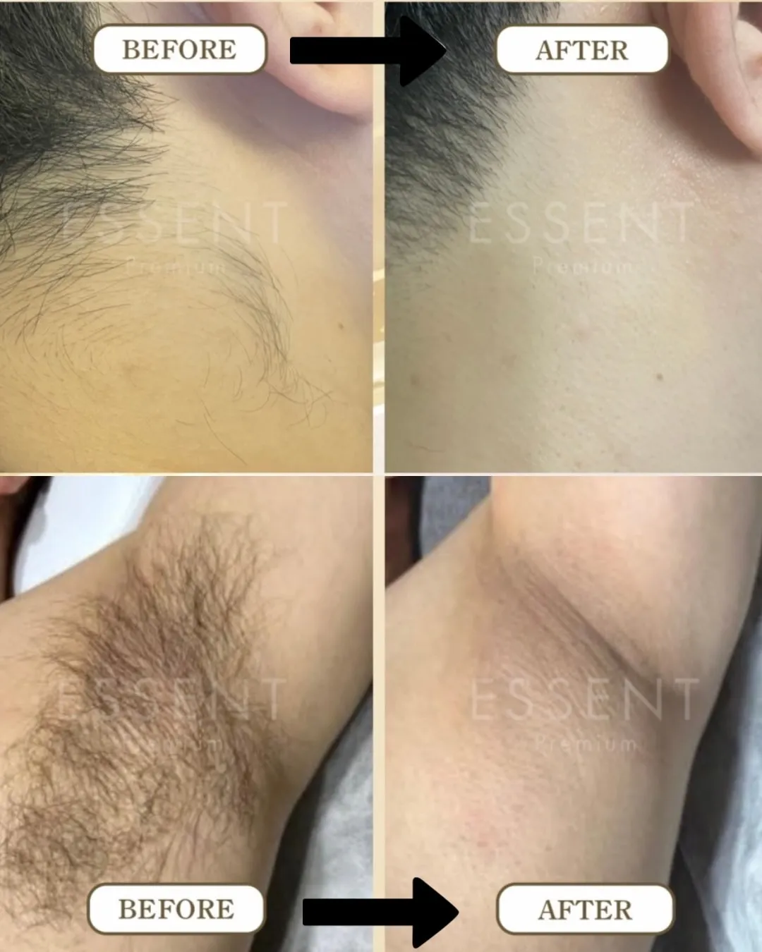 【脱毛の効果をしっかり感じたい方へ】