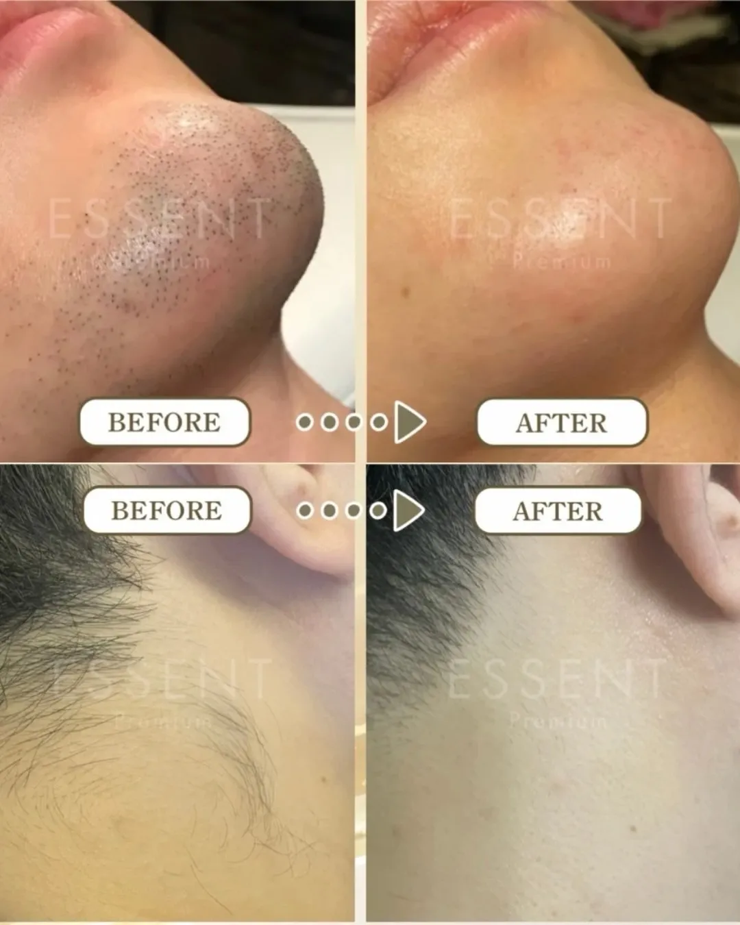 フェイシャルも、脱毛も。