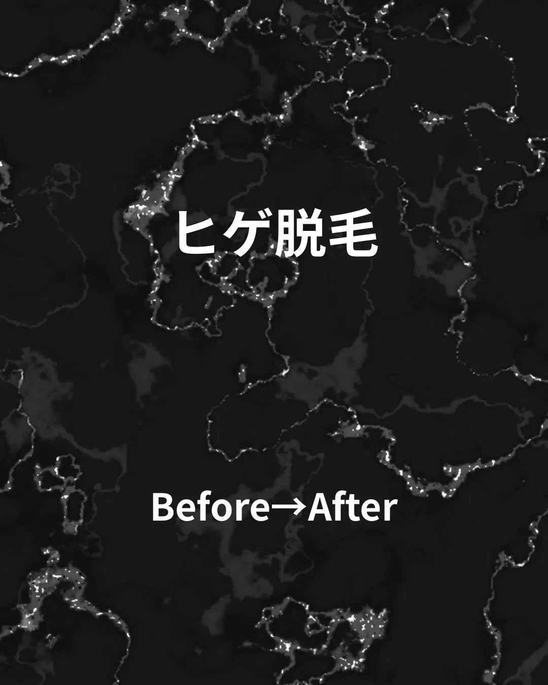 ヒゲ脱毛【1回目】の経過です。