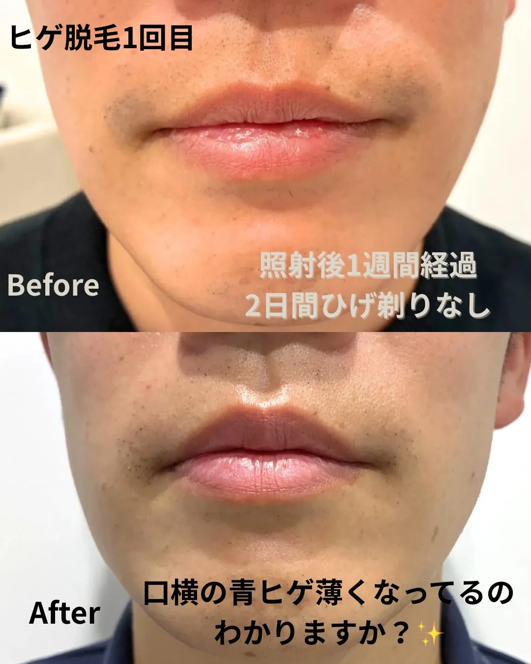 ヒゲ脱毛【1回目】の経過です。