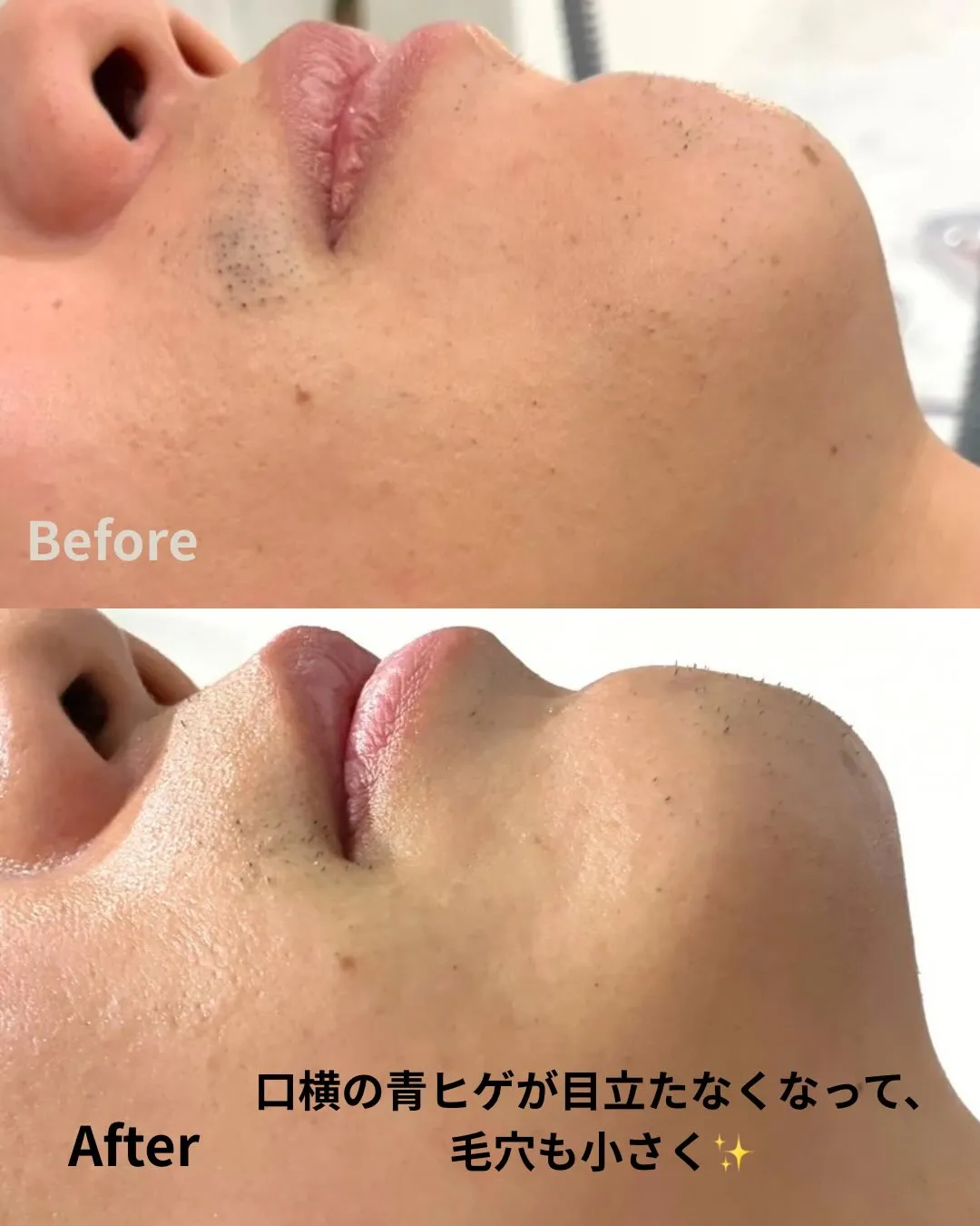 ヒゲ脱毛【1回目】の経過です。