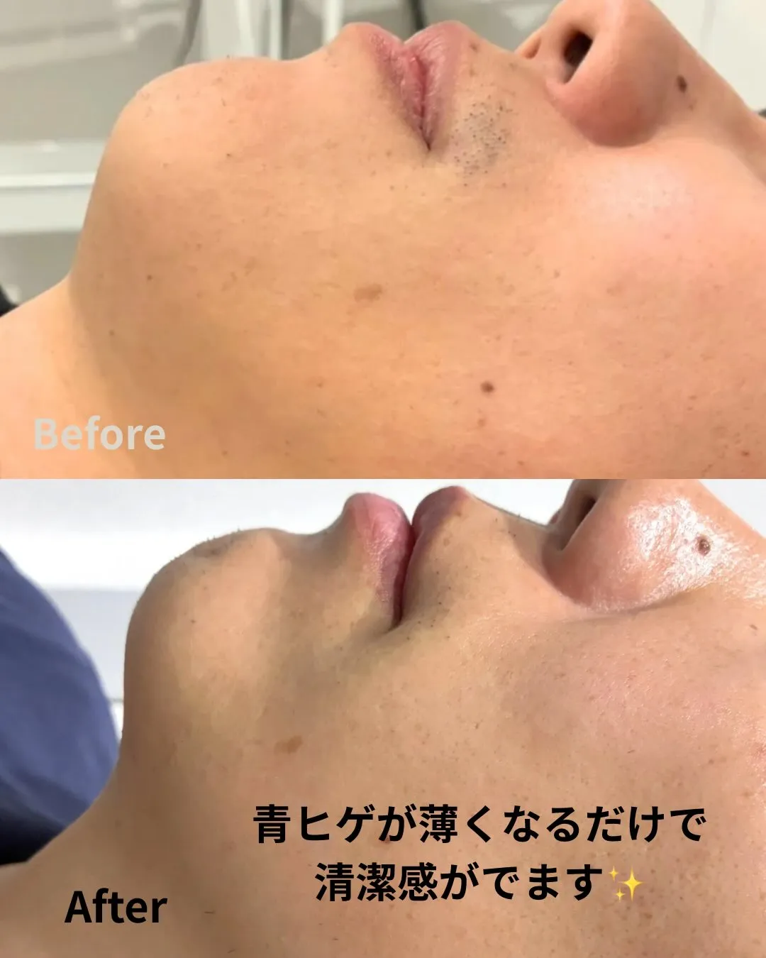 ヒゲ脱毛【1回目】の経過です。