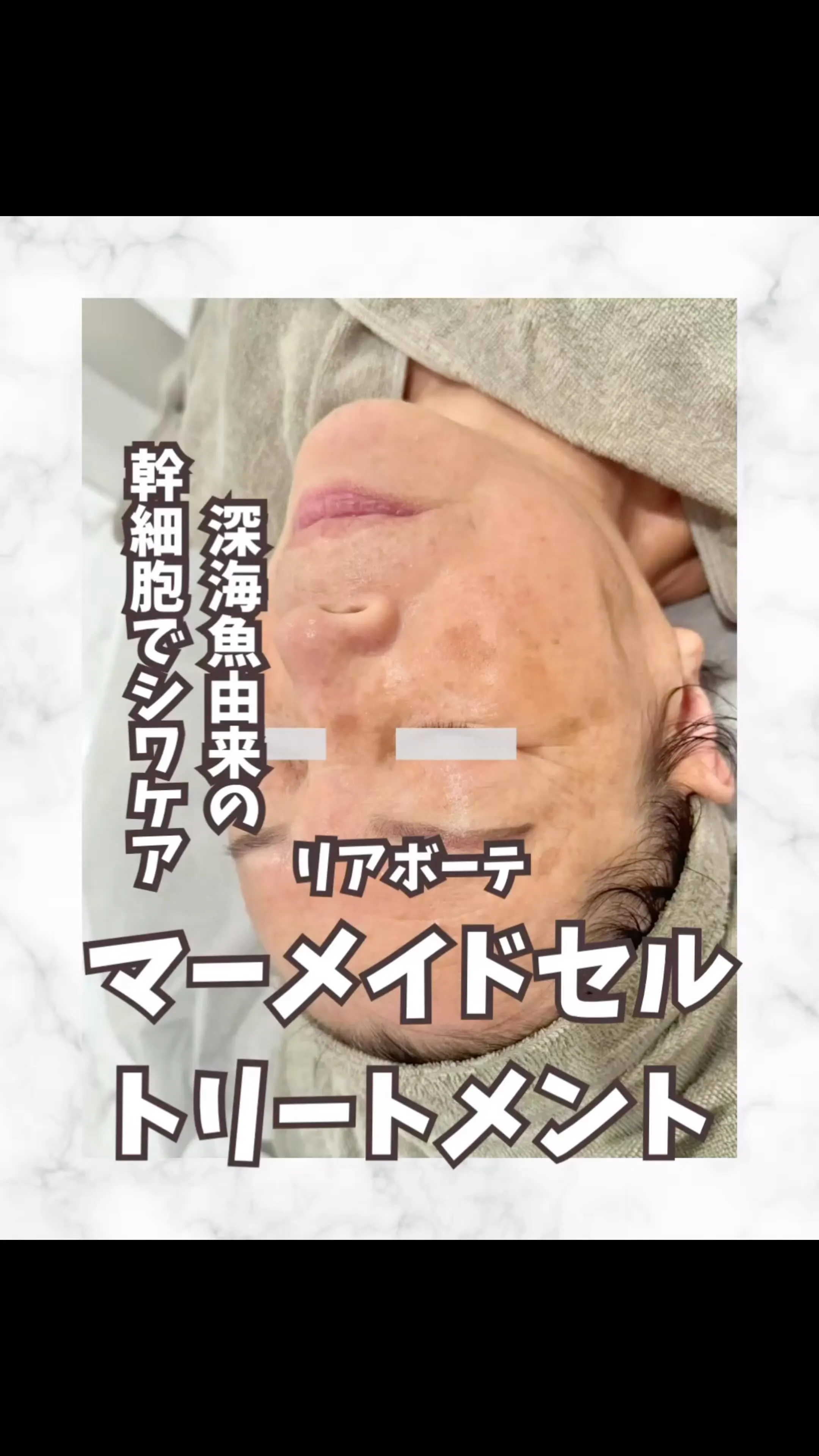 マーメイドセルトリートメントで劇的にシワ改善！！